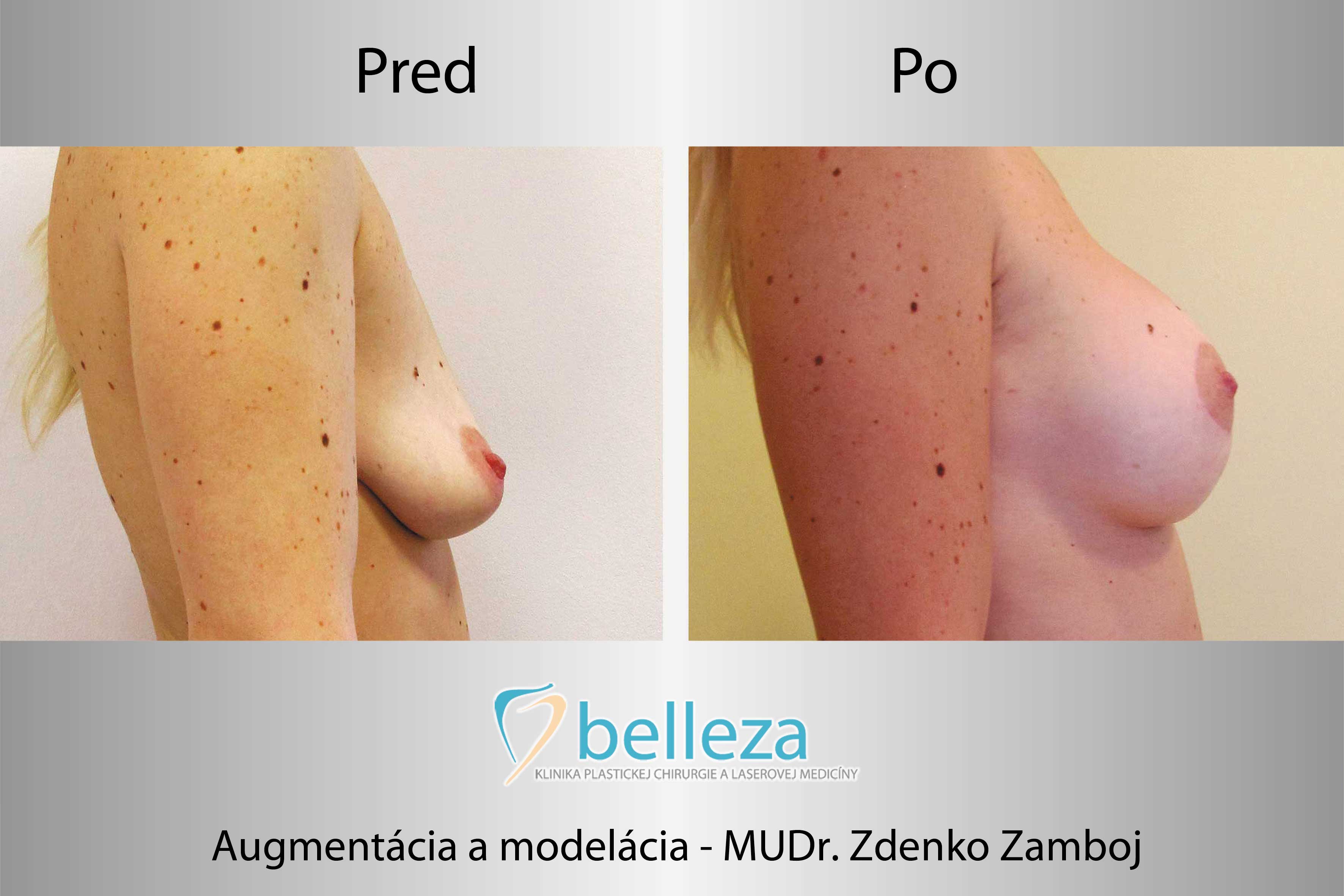 184_belleza_centrum_telo_zvacsenie_prsnikov_zamboj-augment_model_b.jpg