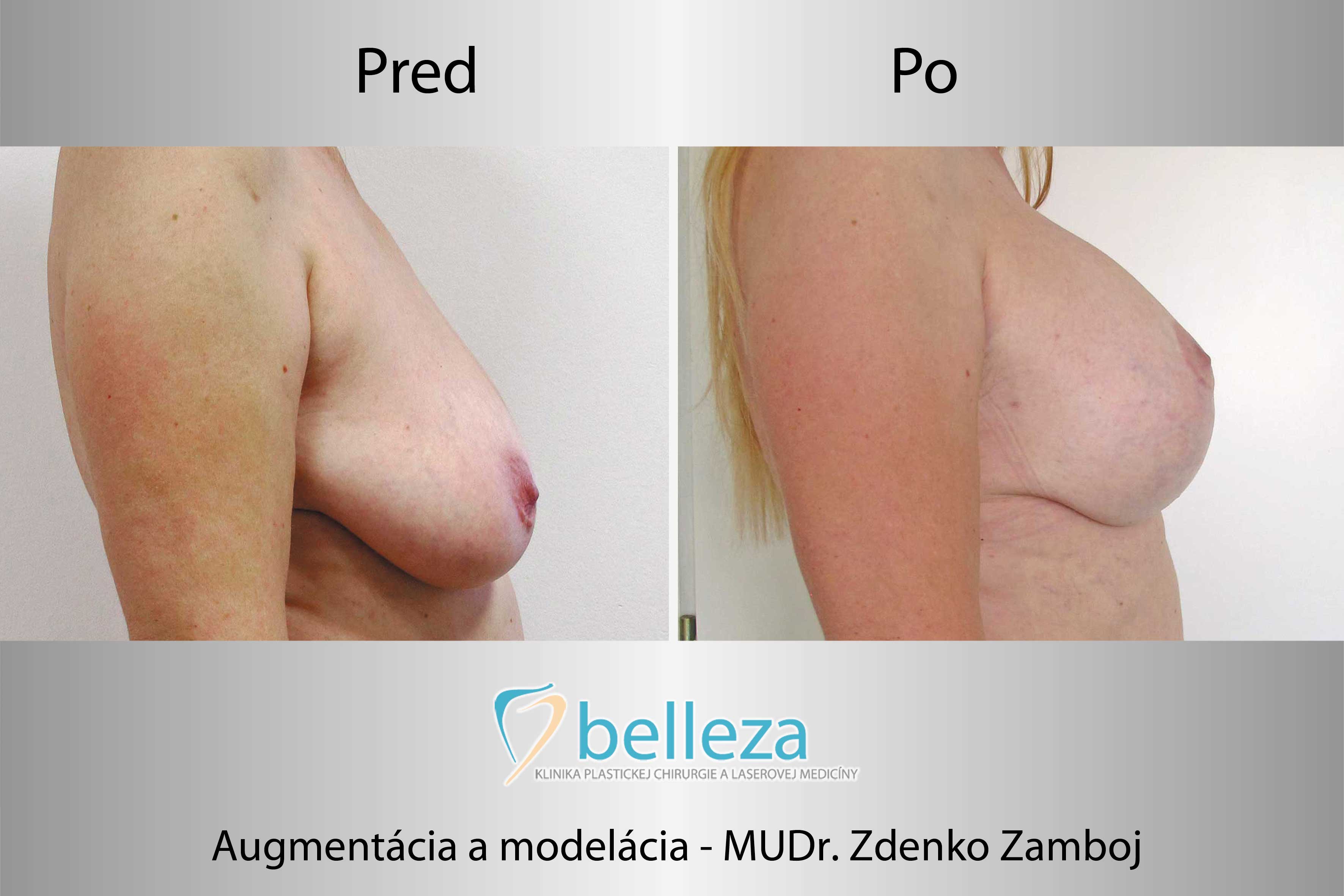 184_belleza_centrum_telo_zvacsenie_prsnikov_zamboj-augment_model_k.jpg