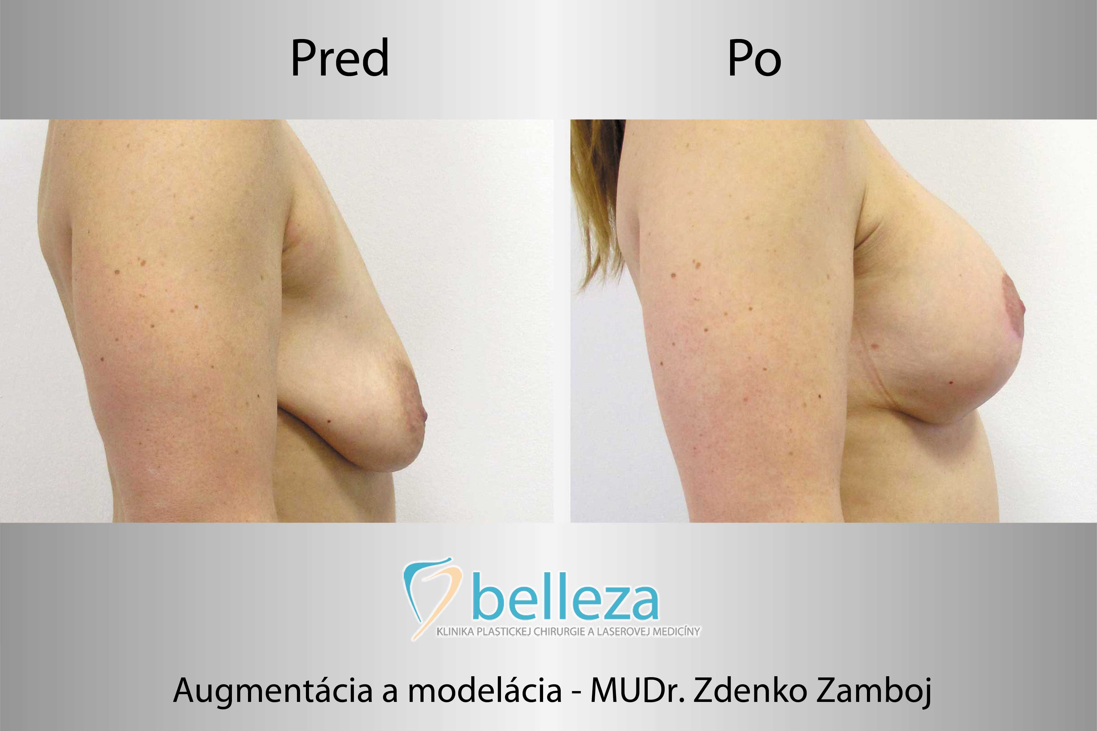 184_belleza_centrum_telo_zvacsenie_prsnikov_zamboj-augment_model_kr.jpg